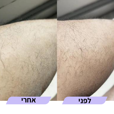 מוחק שיער לפני ואחרי