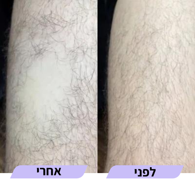 מוחק שיער לפני ואחרי